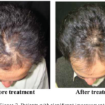 How Traditional Chinese Medicine Treats Hair Loss and Persistent Dandruff