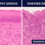 The Gingiva Under the Microscope: Histology of Healthy vs. Diseased Gums