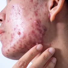 Hormonal Skin Treatment: A Complete Guide to Clear and Balanced Skin Skin issues can be frustrating, especially when they seem to flare up without any clear reason. For many people, breakouts, pigmentation, and sudden sensitivity are linked to hormonal changes. These changes can come from puberty, periods, pregnancy, stress, or even lifestyle habits. Understanding how hormones affect your skin is the first step toward finding the right solution. That’s where hormonal skin treatment comes in—an approach designed to target the root cause, not just the surface problem. Hormonal changes can trigger a wide range of skin concerns, and this is where hormonal skin treatment naturally becomes an effective option. When hormone levels fluctuate, your body can produce too much oil, cause inflammation, or disrupt your skin barrier. This may lead to acne, dullness, dryness, or sudden breakouts that feel impossible to control. Because hormones play such a big part in skin health, finding a treatment that stabilizes these changes can bring long-term improvement. Why Hormones Affect Your Skin Your skin is very sensitive to hormones like estrogen, progesterone, and testosterone. Any imbalance can immediately show up on your face or body. For example: High testosterone can increase oil production, leading to acne. Low estrogen can make the skin dry, thin, and more prone to wrinkles. High cortisol (stress hormone) can trigger inflammation and breakouts. This is why some people experience skin issues around their period, during pregnancy, before menopause, or during stressful times. Hormones are constantly shifting, and so does your skin. Common Skin Issues Caused by Hormones Hormonal imbalances can show up in different ways: Persistent acne or cystic acne Sudden, recurring breakouts Oily T-zone and dry cheeks Dark patches or pigmentation (melasma) Skin sensitivity or redness Premature aging signs like fine lines If you're dealing with any of these, it might be time to consider treatments tailored specifically to hormonal changes. Types of Hormonal Skin Treatments The right treatment depends on your specific skin needs and what your hormones are doing. Some of the most effective options include: 1. Topical Treatments Dermatologists often prescribe topical creams or gels containing ingredients like: Retinoids Salicylic acid Benzoyl peroxide Azelaic acid These help reduce inflammation, unclog pores, and regulate skin cell turnover. 2. Oral Medications For severe hormonal acne or persistent breakouts, oral treatments may be recommended such as: Birth control pills Spironolactone Antibiotics (short-term) Isotretinoin (for severe acne cases) These medicines help balance hormones internally or reduce oil production. 3. Professional Skin Treatments Dermatologists may also suggest in-clinic procedures for faster and more noticeable results: Chemical peels LED light therapy Microneedling Laser treatments These treatments help remove dead skin, reduce pigmentation, and stimulate collagen. 4. Diet and Lifestyle Adjustments Because hormones respond to your habits, lifestyle changes can play a big role: Eating a balanced, low-sugar diet Managing stress through yoga or meditation Getting enough sleep Keeping skin-care products gentle and non-comedogenic These small changes can support your hormonal balance and improve your skin from within. How to Know If You Need Hormonal Skin Treatment If your breakouts or skin issues seem to come in cycles, worsen during stress, or don’t respond to regular skincare, hormones are likely involved. People who experience deep, painful pimples around the jawline often have hormonally driven acne. Women going through PCOS, pregnancy, or menopause are also more likely to benefit from these treatments. A dermatologist can evaluate your symptoms and suggest a treatment plan that fits your skin type and hormonal levels. Benefits of Hormonal Skin Treatment Choosing a treatment designed for hormonal issues offers several advantages: Long-term relief instead of temporary results Clearer, smoother skin Balanced oil production Reduced inflammation and redness Improvement in pigmentation Stronger and healthier skin barrier Most importantly, these treatments focus on correcting the root cause, which leads to more stable and lasting results. Final Thoughts Hormonal skin problems can feel overwhelming, but you don’t have to deal with them alone. With the right hormonal skin treatment, you can restore balance to your skin and achieve long-lasting clarity. Whether your symptoms are mild or severe, working with a dermatologist can help you choose the best path toward healthier, glowing skin. Clear skin is possible when you treat the cause—not just the symptoms.