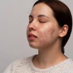 Retin-A for Acne and Wrinkles: Benefits, Before-After Results & Precautions