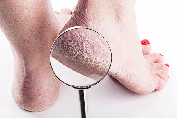 Why Cracked Heels and Calluses Keep Coming Back (And the Smart Way to Fix Them)
