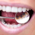 Hidden but Powerful: How Lingual Braces Move Teeth More Precisely