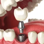 Dental Appliances for Missing Teeth: What Patients Are Choosing Today in the U.S.