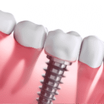 What Happens If You Delay Getting a Dental Implant?