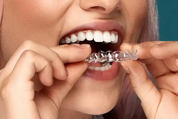 Teeth Straightening Options: Why Clear Aligners Are the Future