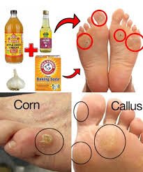 The Best Remedy for Calluses: How to Get Off Hard Skin Without Hurting Oneself