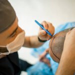 Understanding the Full Process of Hair Transplant Turkey