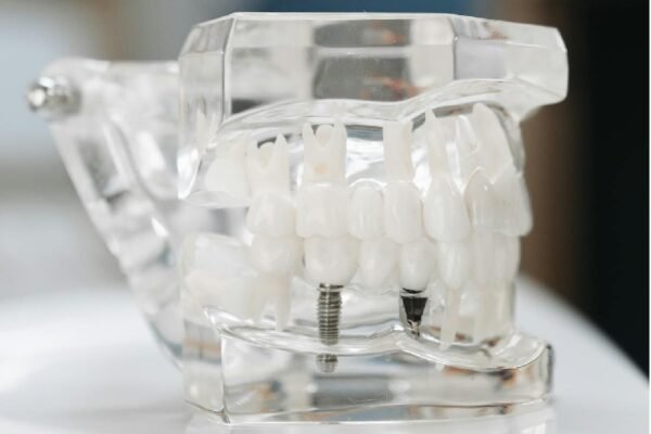 Your Guide To Getting Dental Implants