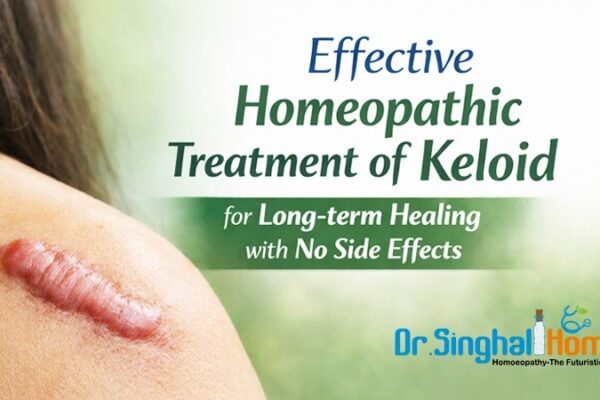 treatment for keloids in homeopathy