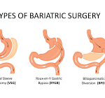 What Are the Three Stages of Bariatric Surgery?