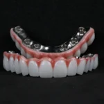 All-on-4 and All-on-6 in Turkey: Inside DentPrime’s Implant Approach