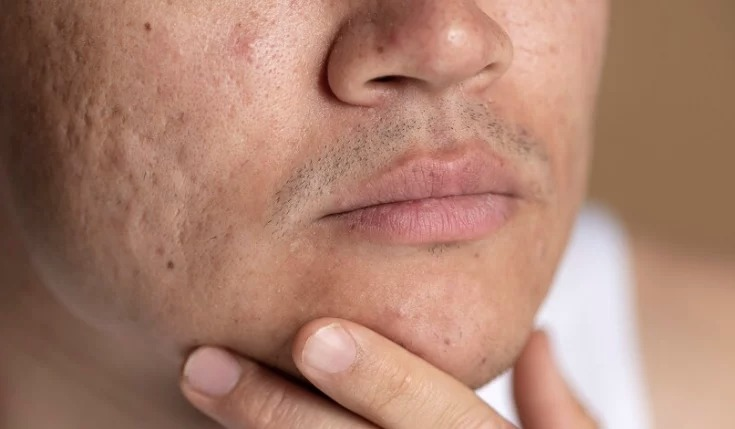 Three Types of Acne Scars and Their Treatments Accordingly