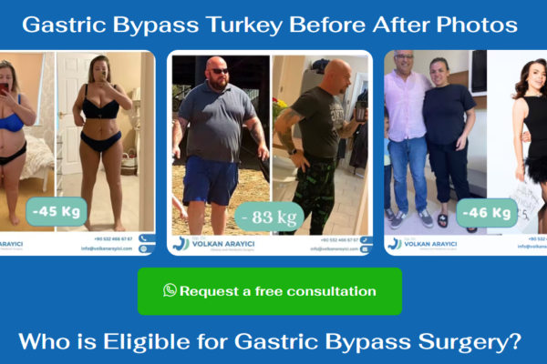 Your Complete Guide to Gastric Sleeve Surgery in Turkey