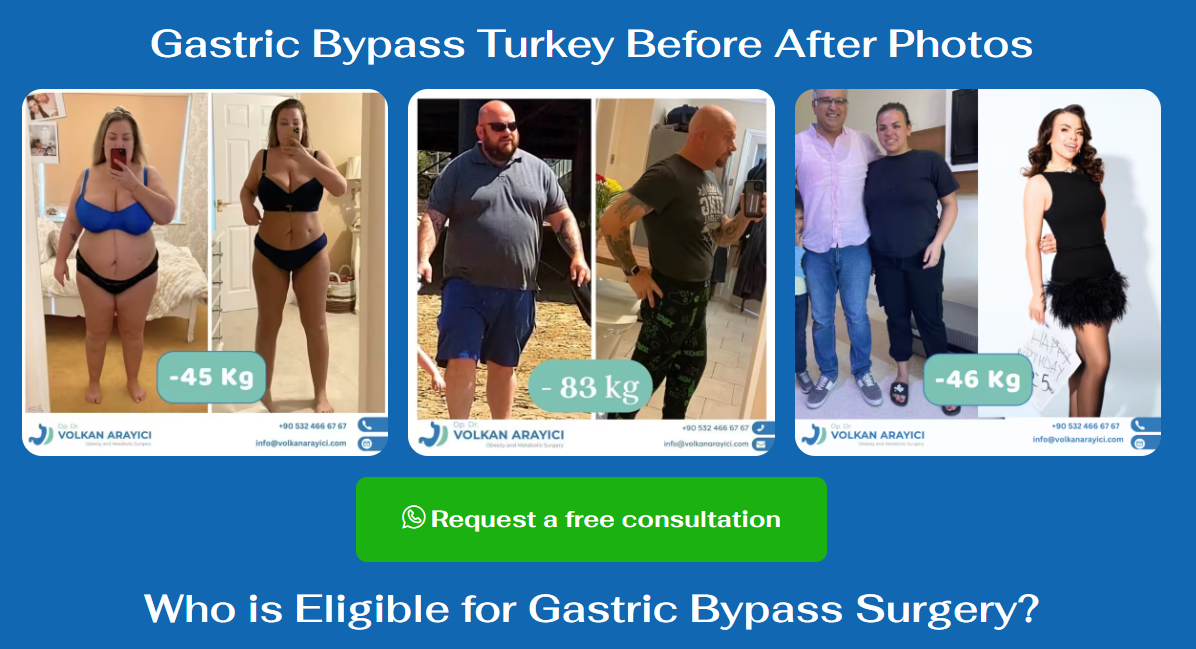 Your Complete Guide to Gastric Sleeve Surgery in Turkey