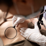 Why Getting Skin Cancer Surgery in Gold Coast Early Makes All the Difference to Your Recovery