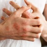 What Is a Psoriasis Clinical Trial and Could You Qualify?