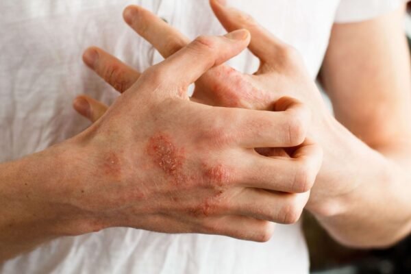 psoriasis treatment lake worth fl 1 scaled 1