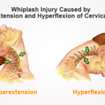 How Long Does It Really Take to Recover From a Whiplash Injury?