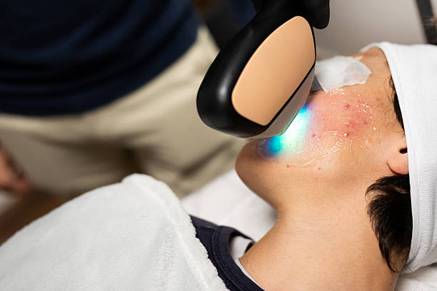 IPL Acne Treatment