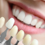 Teeth Whitening in Canberra: What Actually Works (and How to Find the Right Dentist for It)