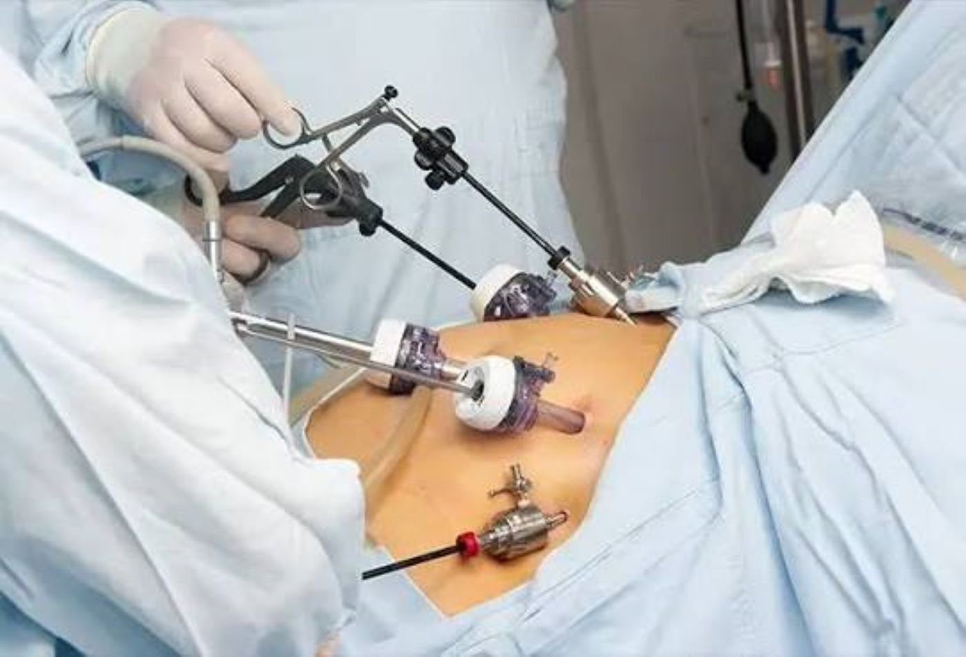 Can You Live a Normal Life After Bariatric Surgery? 2 images 2