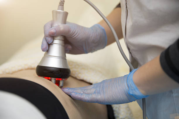 radio frequency lipolysis